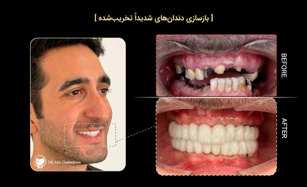 بازسازی دندان های تخریب شده با ایمپلنت